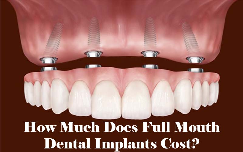 Dentures Near Me >> Me Cheapest Dental Near Implants Dentures Near Me >> Me Cheapest Dental Near Implants