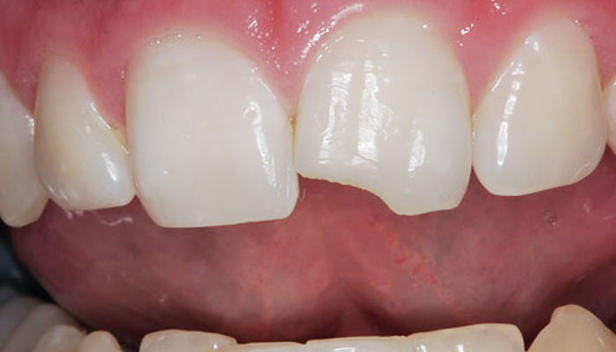 chipped-tooth-cost