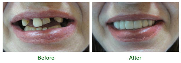 dental-implants-miami